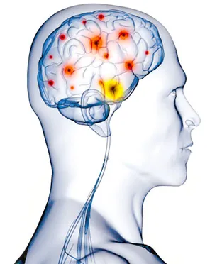 Cluster Headache - The Basics